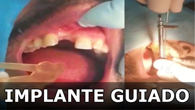Full Techno Surgery | Implante Dentário Guiado